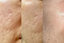 best ingredients for scar healing