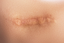 close-up of a raised keloid scar on human skin
