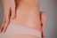 Stretch Mark Camouflage Treatment | Expert Guide by NUE Conceal