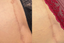 stretch mark removal near me
