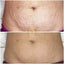 stretch mark tattoo removal